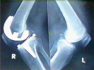 RADIOGRAFIA RODILLAS · IMAGENES FOTOS